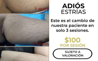 Elimina las estrías con nuestro increíble láser.