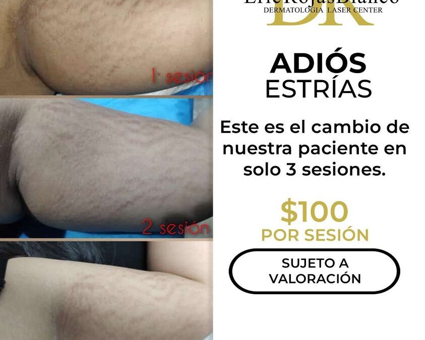 Elimina las estrías con nuestro increíble láser.