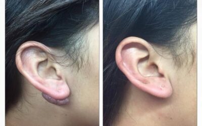 Queloide en la oreja