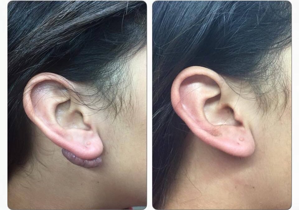 Queloide en la oreja