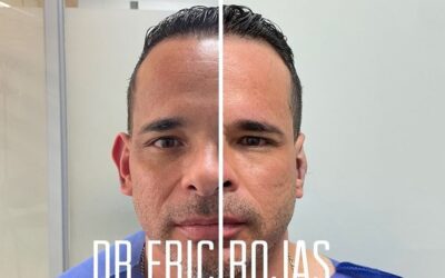 Contamos con la mejor técnica para corregir tus orejas