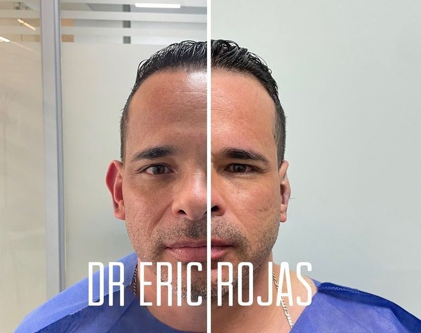 Contamos con la mejor técnica para corregir tus orejas