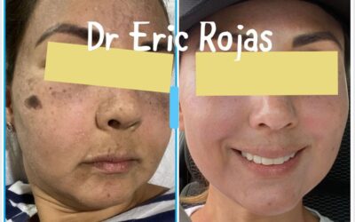 Tratamos Melasma y generamos un cambio en ti.