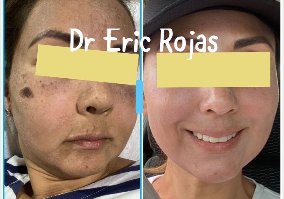 Tratamos Melasma y generamos un cambio en ti.