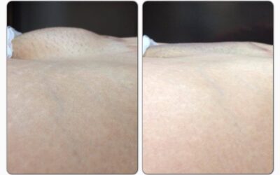 Ahora puedes eliminar ese exceso de pubis en menos de 10 minutos y sin riesgos con Slim Láser.