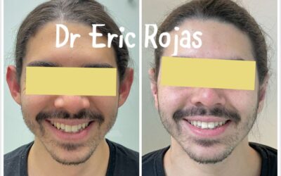 Dermo Otoplastía, el mejor procedimiento para corregir tus orejas.