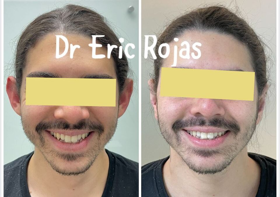 Dermo Otoplastía, el mejor procedimiento para corregir tus orejas.