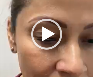 Blefaroplastia con anestesia local, cero molestias y con resultados extraordinarios.