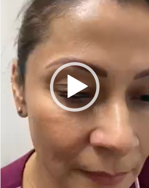 Blefaroplastia con anestesia local, cero molestias y con resultados extraordinarios.