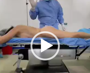 Transferencia a glúteos con Slim Láser.