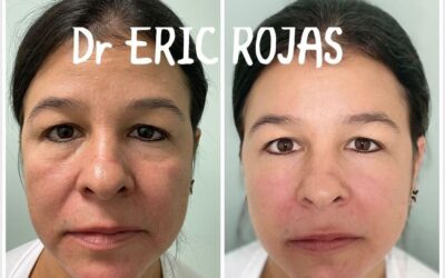 Rejuvenece tu rostro con la mejor técnica.