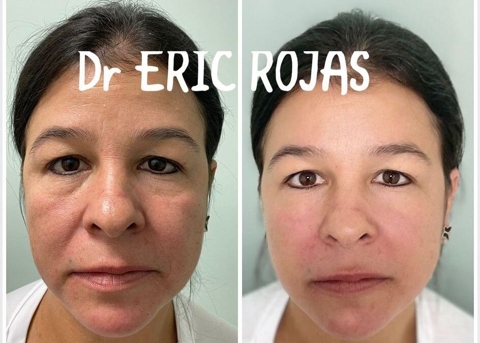 Rejuvenece tu rostro con la mejor técnica.