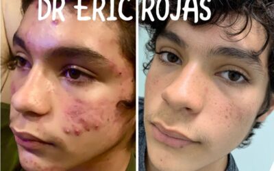 | Eliminar el acné es posible con nosotros, no esperes más, somos un centro especializado en el tratamiento del acné.