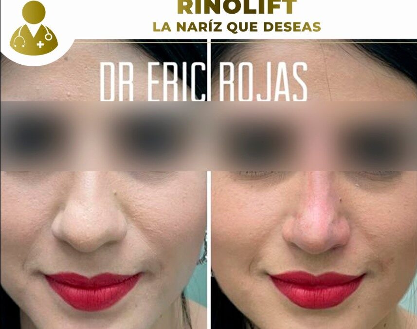 Rinolift, perfila tu nariz con nuestra técnica.