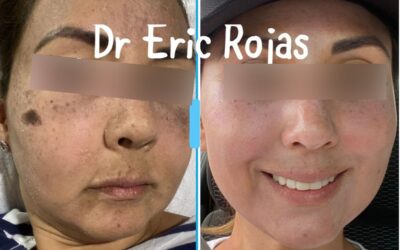 Elimina las manchas de tu rostro.