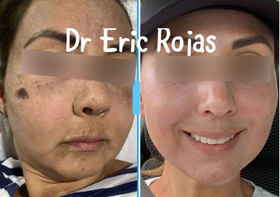 Elimina las manchas de tu rostro.