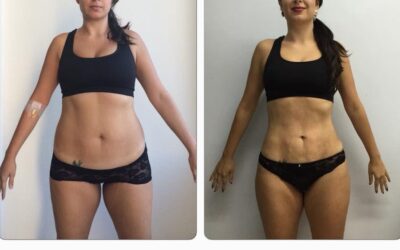 Increíbles cambios con Slim Láser, los cambios que puedes obtener.