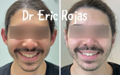 Dermo Otoplastía, la mejor técnica para corregir tus orejas.