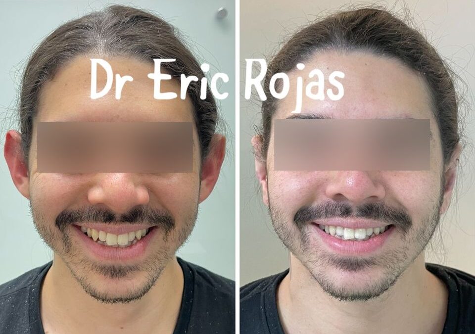 Dermo Otoplastía, la mejor técnica para corregir tus orejas.