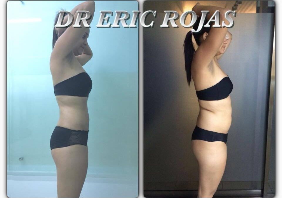 Increíbles resultados con el mejor procedimiento, Slim Láser.