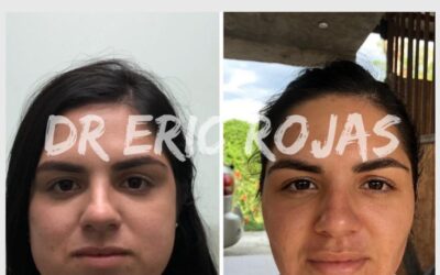 Con la Bichectomía puedes perfilar tu rostro y lucir increíble.