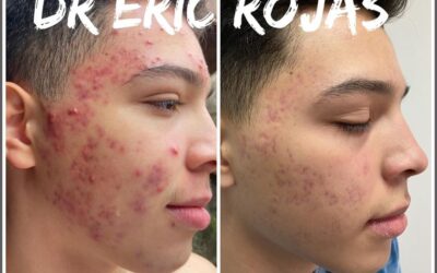 Vuelve a tener tu rostro limpio y sin acné.