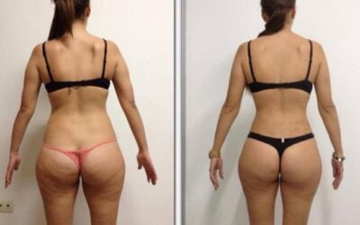Slim Láser es la mejor técnica y tecnología para moldear tu cuerpo.