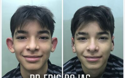 La dermo Otoplastía se utiliza para corregir las orejas, dando una mejor apariencia.