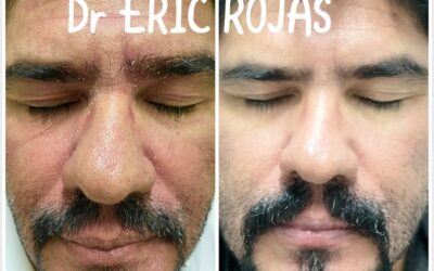 DERMATITIS SEBORREICA NOSOTROS LA MEJORAMOS DR ERIC ROJA