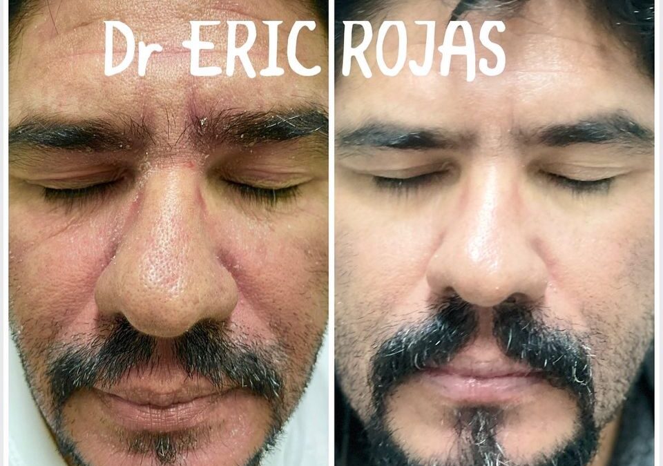 DERMATITIS SEBORREICA NOSOTROS LA MEJORAMOS DR ERIC ROJA