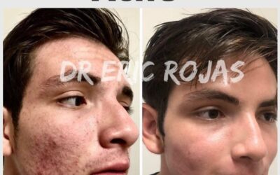 Limpia tu rostro del acné, con el mejor tratamiento.