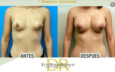 Aumento de senos de $2700 dólares en adelante, obtén tu cambio.