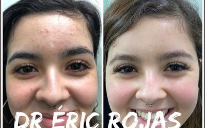 Elimina el acné de tu vida, limpia tu rostro.