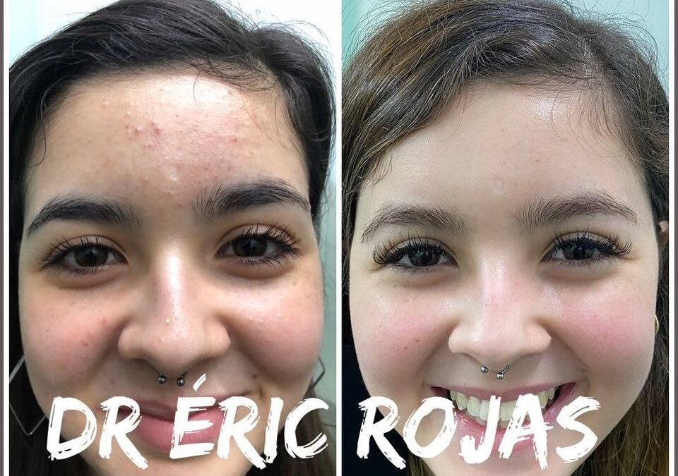 Elimina el acné de tu vida, limpia tu rostro.