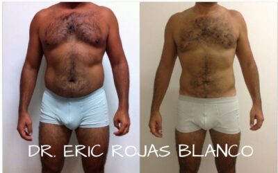 El Slim Láser genera estos increíbles cambios.