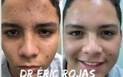 Limpia tu rostro de acné y luce tu rostro perfecto.