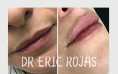 Relleno de labios en promoción $399 dólares para obtener tu moldeado, te esperamos.