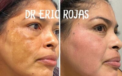 ¿Tienes manchas en tu rostro?, Nosotros podemos ayudarte.