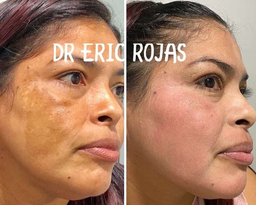 ¿Tienes manchas en tu rostro?, Nosotros podemos ayudarte.