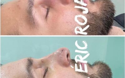 Rinolift es el procedimiento ideal para mejorar tu perfil.