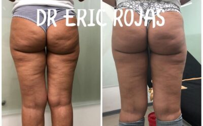 Disminuye la celulitis con nuestro láser