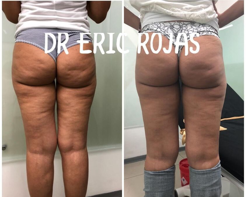 Disminuye la celulitis con nuestro láser