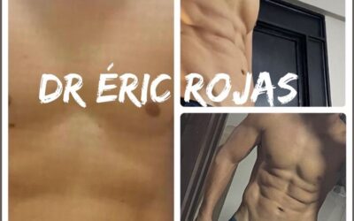 Slim láser, resultados increíbles con marcaje.