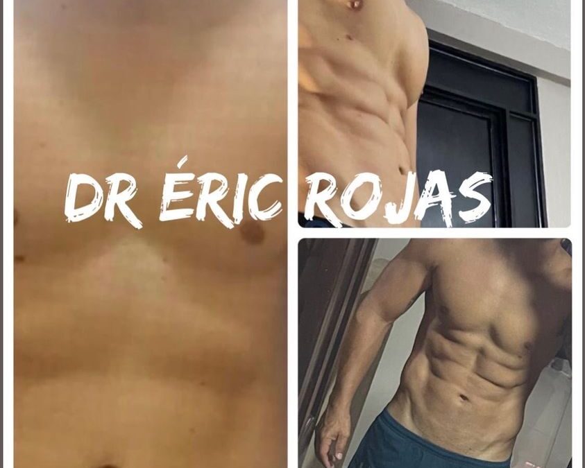 Slim láser, resultados increíbles con marcaje.