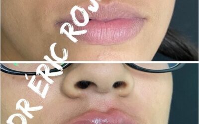 Relleno de labios en una increíble promoción $400 dólares.