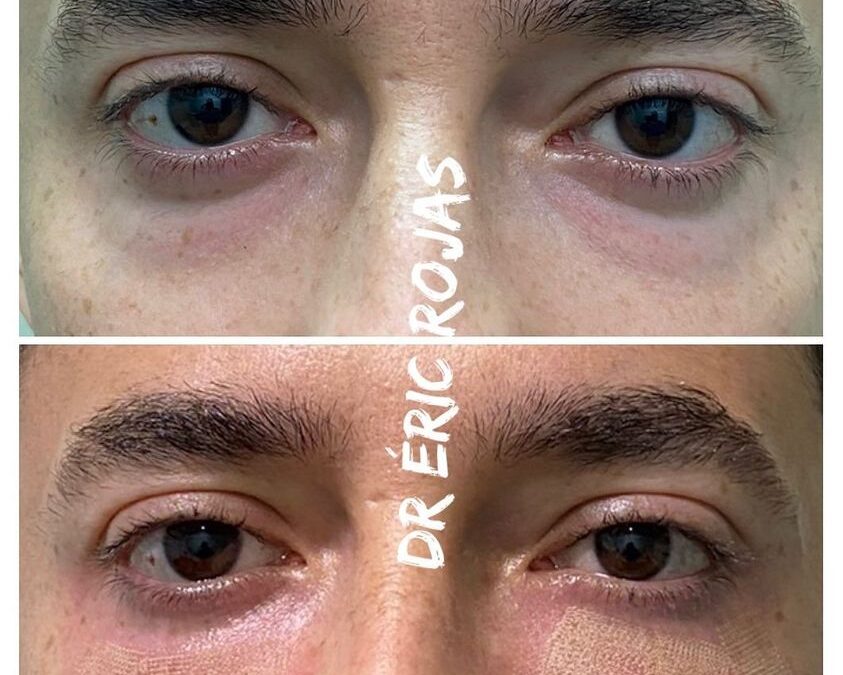 Elimina las ojeras de tu rostro.