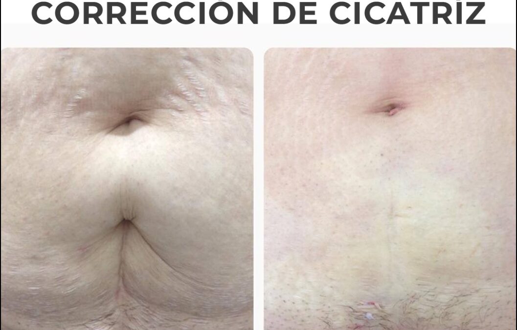 Corrección de cicatrices, ven a valoración para brindarte tu presupuesto, podemos ayudarte.