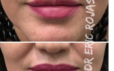 Relleno de labios en $400 dólares, no esperes más.
