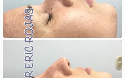 Rinolift, mejora tu perfil en minutos.