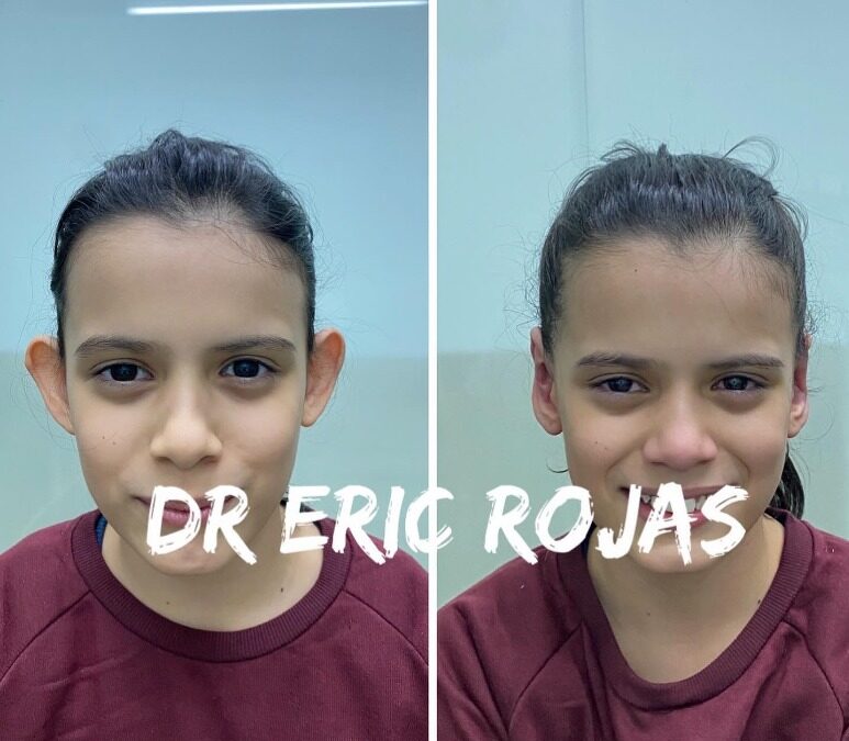 Dermo Otoplastía es la mejor técnica para corregir tus orejas, por solo $950 dólares